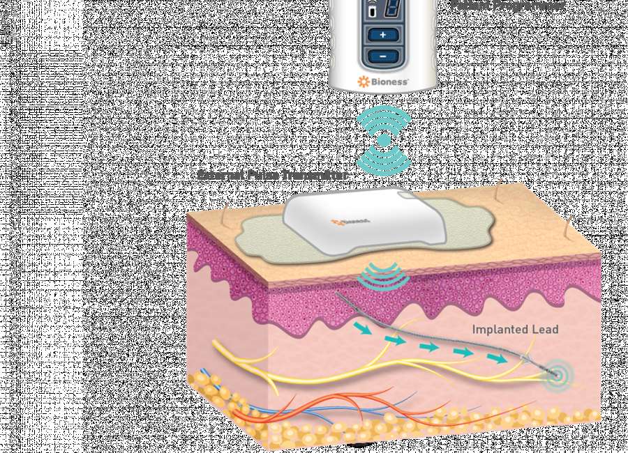 StimRouter option to combat pain